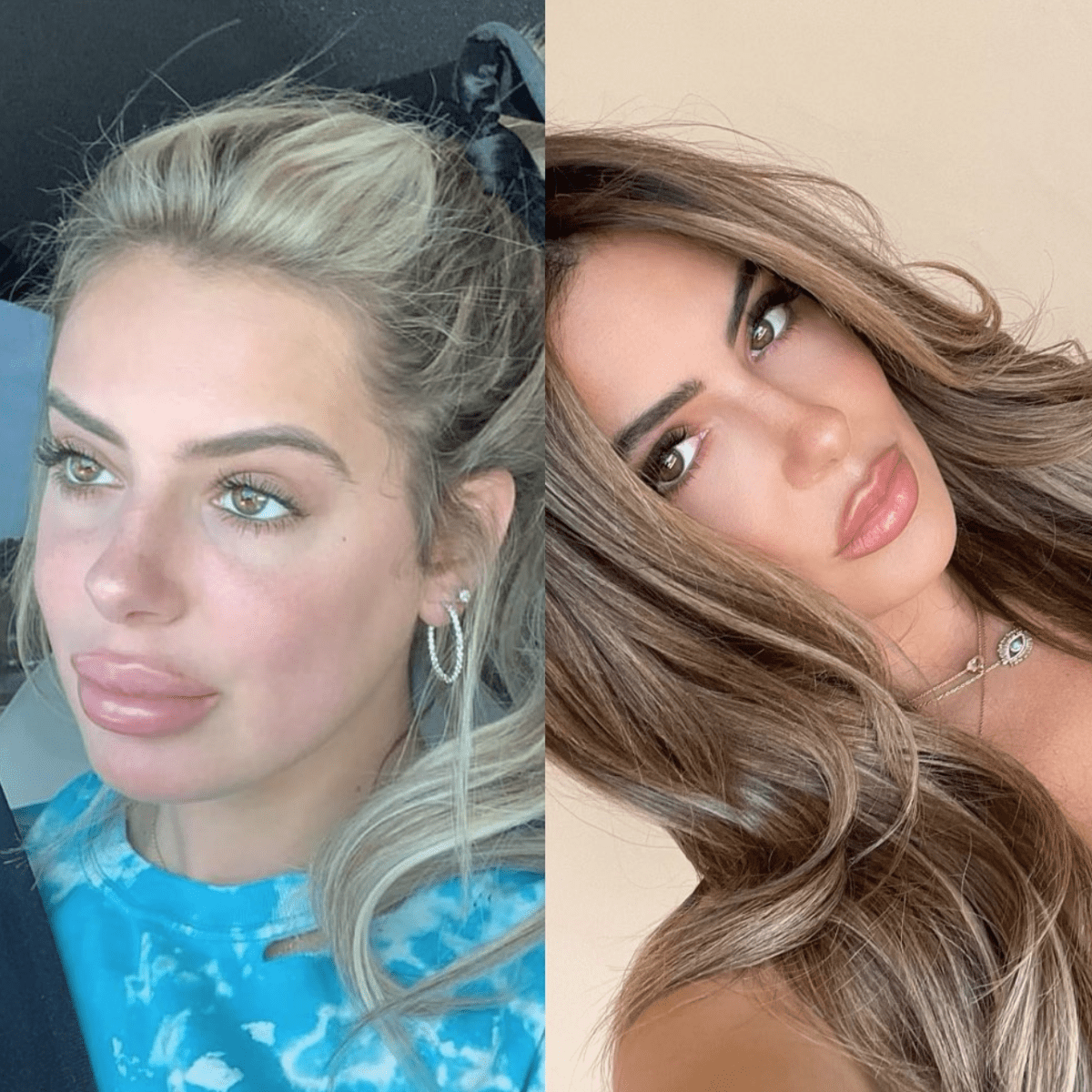 Brielle Biermann shares before and after photos of lip injection correction