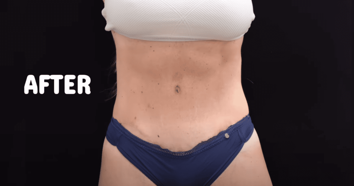 RHONJ's Danielle Cabral shares tummy tuck results