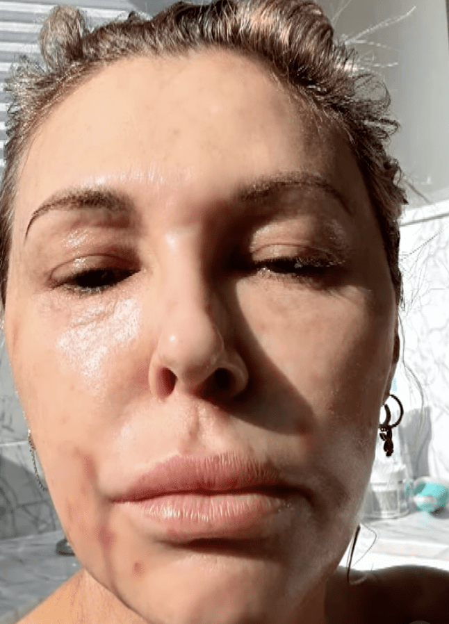 Brandi Glanville shows off facial swelling caused by stress-induced angioedema